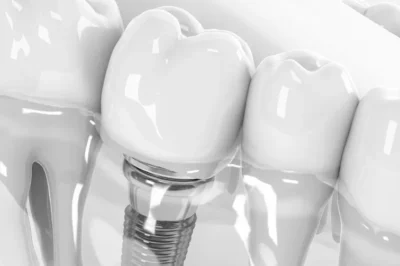 Single Implants Aberdeen: A Simple Solution for Missing Teeth