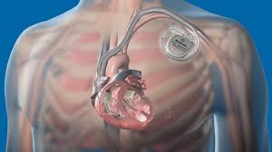 Cardiac Bio Implant Devices Market Analysis Size And Forecast Report 2024-2032