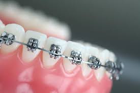 Global Orthodontics Market Analysis Size And Forecast Report 2024-2030