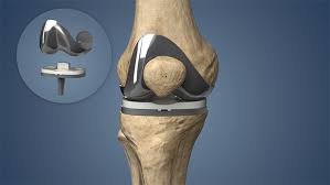 Knee Replacement Market Analysis Size And Forecast Report 2024-2032