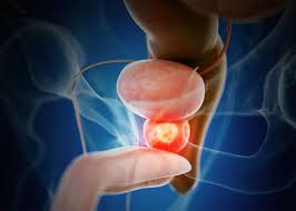 Prostate Cancer Diagnostics Market Analysis Size And Forecast Report 2024-2032 Prostate Cancer Diagnostics Market Analysis Size And Forecast Report 2024-2032