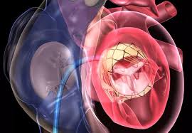 Transcatheter Heart Valve Replacement Market Analysis Size And Forecast Report 2024-2032