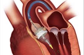 Transcatheter Heart Valve Replacement Market Analysis Size And Forecast Report 2024-2032