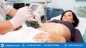 United States Biopsy Market Analysis Size And Forecast Report 2023-2028 United States Biopsy Market Analysis Size And Forecast Report 2023-2028