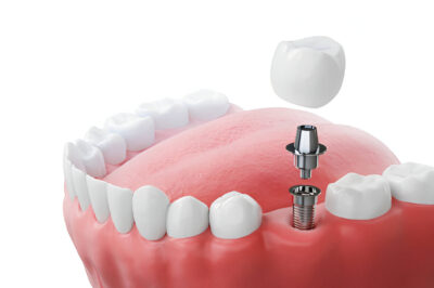 Dental Implants in Aberdeen: A Comprehensive Guide