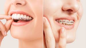 Braces vs. Clear Aligners: Which Orthodontic Treatment is Right for You?