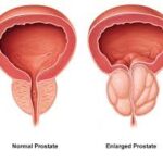 Tests to Diagnose Prostate Cancer