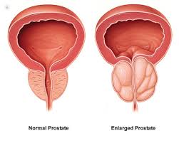 Tests to Diagnose Prostate Cancer