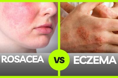 Eczema vs Rosacea on Face: Symptoms, Causes, and Treatment