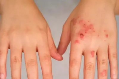 Ceftriaxone: What You Need to Know About This Antibiotic