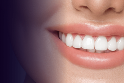 Best Teeth Whitening in Dubai: Top Clinics & Treatments for a Brighter Smile