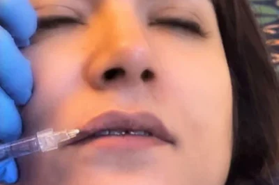 How Long Does It Take to See Results From PRP in Fairfax?