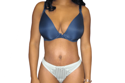 How Long Is the Recovery Process After Belly Fat Removal Surgery? How Long Is the Recovery Process After Belly Fat Removal Surgery?