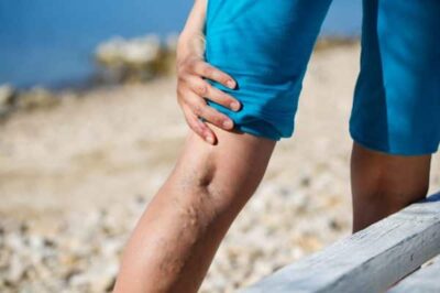 Do You Need a Vein Specialist? Here’s How to Know!