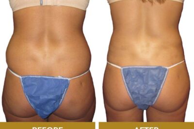 How Do You Choose the Best BBL Surgeon?