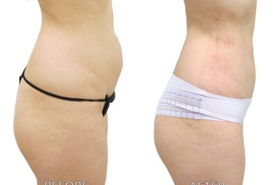 Who Offers the Safest and Best BBL Surgery Experience?