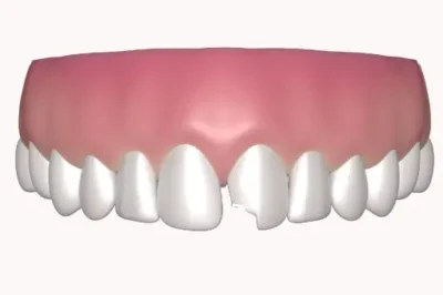 Who Offers the Best Cheap Teeth Bonding Services?
