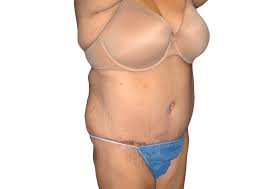 How Long Does Chin Liposuction Recovery Take?