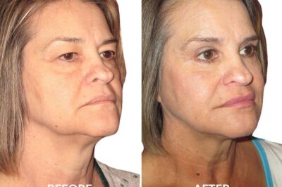 How Long Does It Take to Recover from Neck Liposuction?