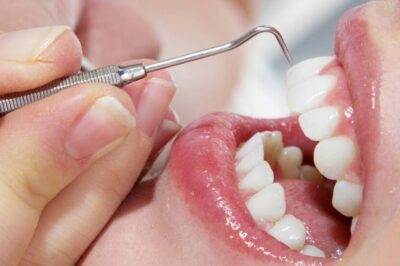 Is Professional Teeth Cleaning Necessary If You Brush Daily?