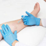 How Much Should You Budget for Vein Removal Surgery?
