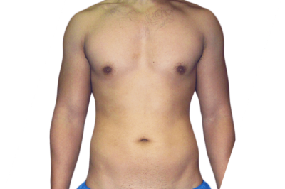 What Are the Risks or Side Effects of Laser Liposuction? What Are the Risks or Side Effects of Laser Liposuction?