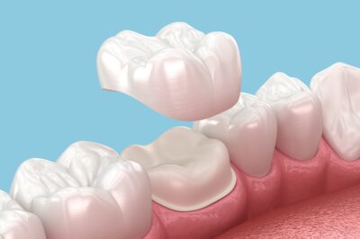 What Should I Know Before Getting a Dental Crown Near Me?