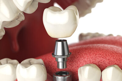 How Long Do Dental Implants Last?