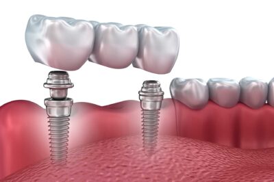 How Long Does the Dental Implant Procedure Take in New York? How Long Does the Dental Implant Procedure Take in New York?
