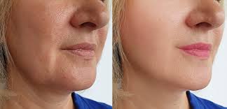 Trådlyft stockholm – Skönhetsbehandling med naturliga resultat Trådlyft stockholm – Skönhetsbehandling med naturliga resultat