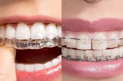 How Long Does Invisalign Treatment Take with a Dentist?
