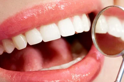 Is a Porcelain Veneer the Right Choice for Your Teeth?