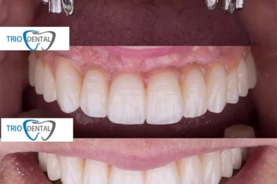 Soluzioni Moderne per il Sorriso: L’Eccellenza degli Impianti Dentali Albania e dell’Impianto Dentario