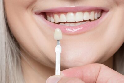 How Long Does a Smile Makeover Take in Houston?