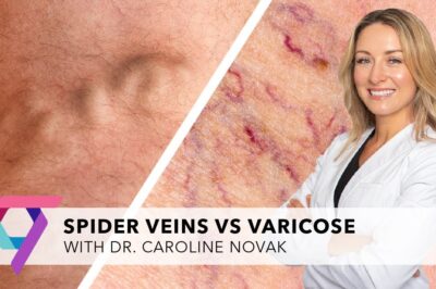 Do I Need a Vascular Surgeon or a Phlebologist for Vein Treatment?